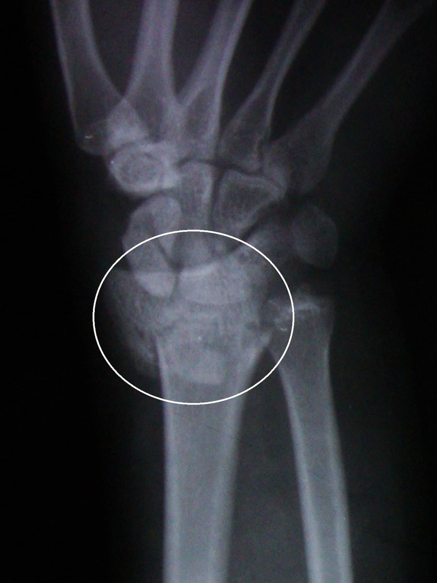 PA wrist X-ray of a Colles fracture with a comminuted distal radius and ulnar styloid fracture