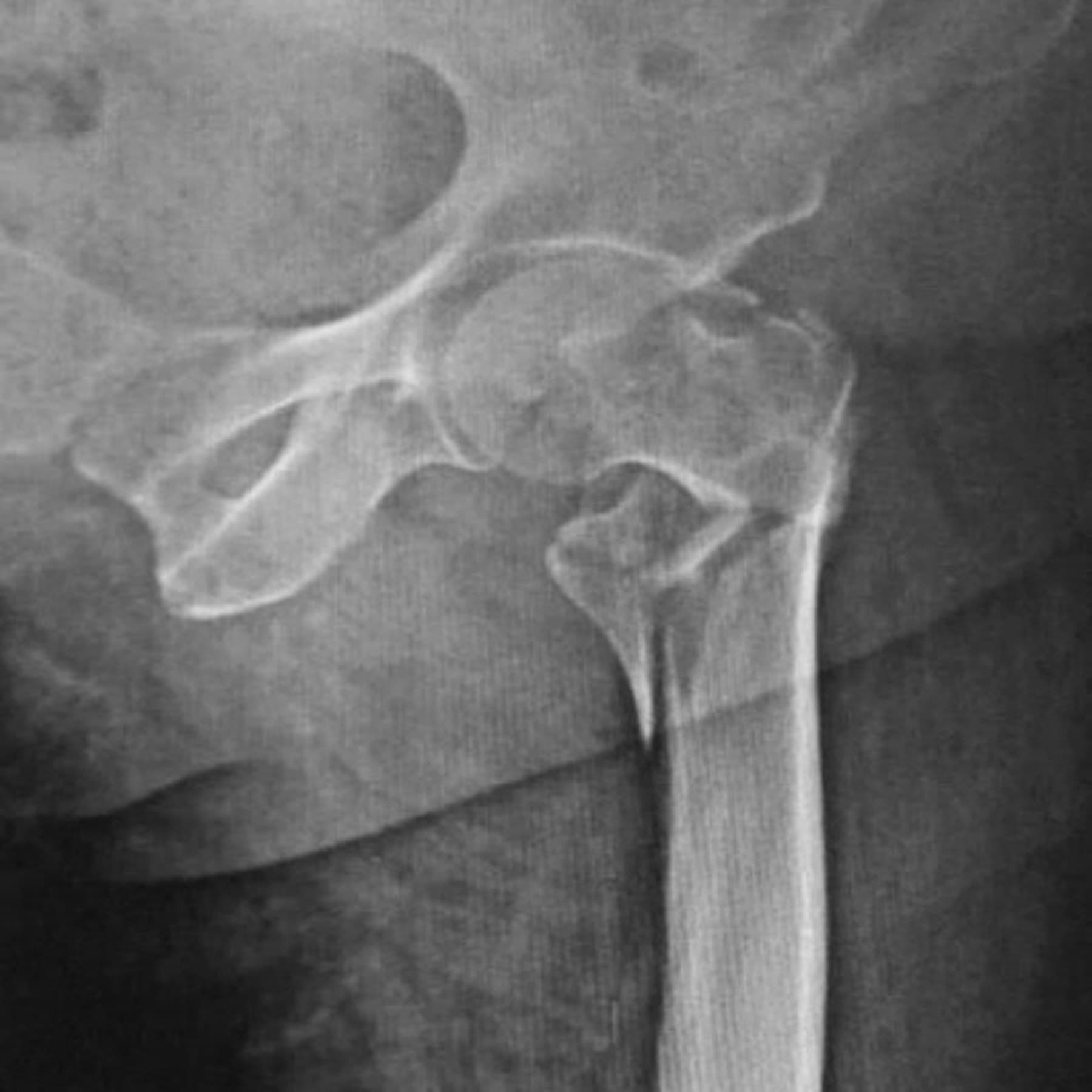 AP X-ray of a comminuted trochanteric hip fracture