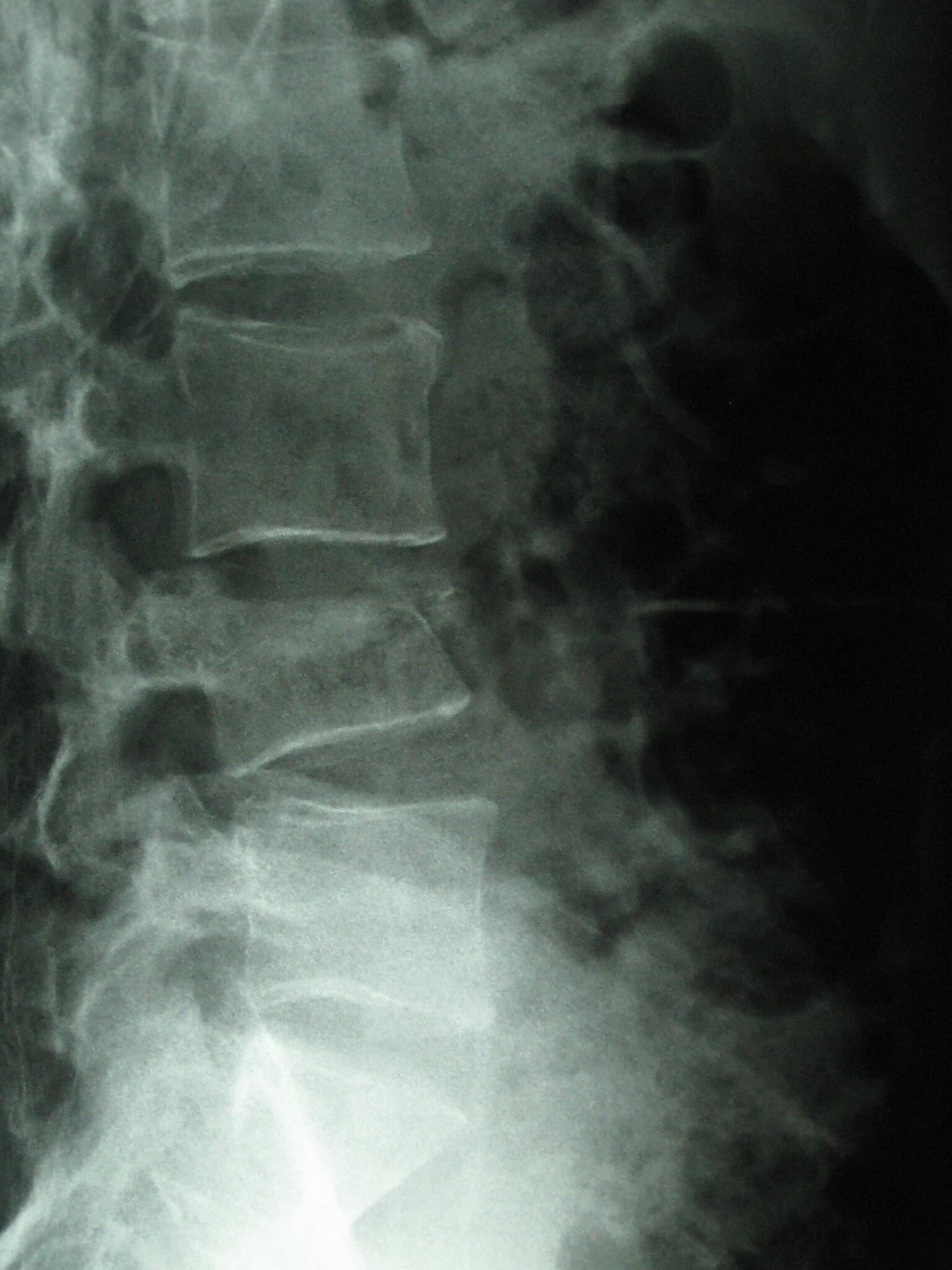 Lateral lumbar spine X-ray of an L4 compression fracture