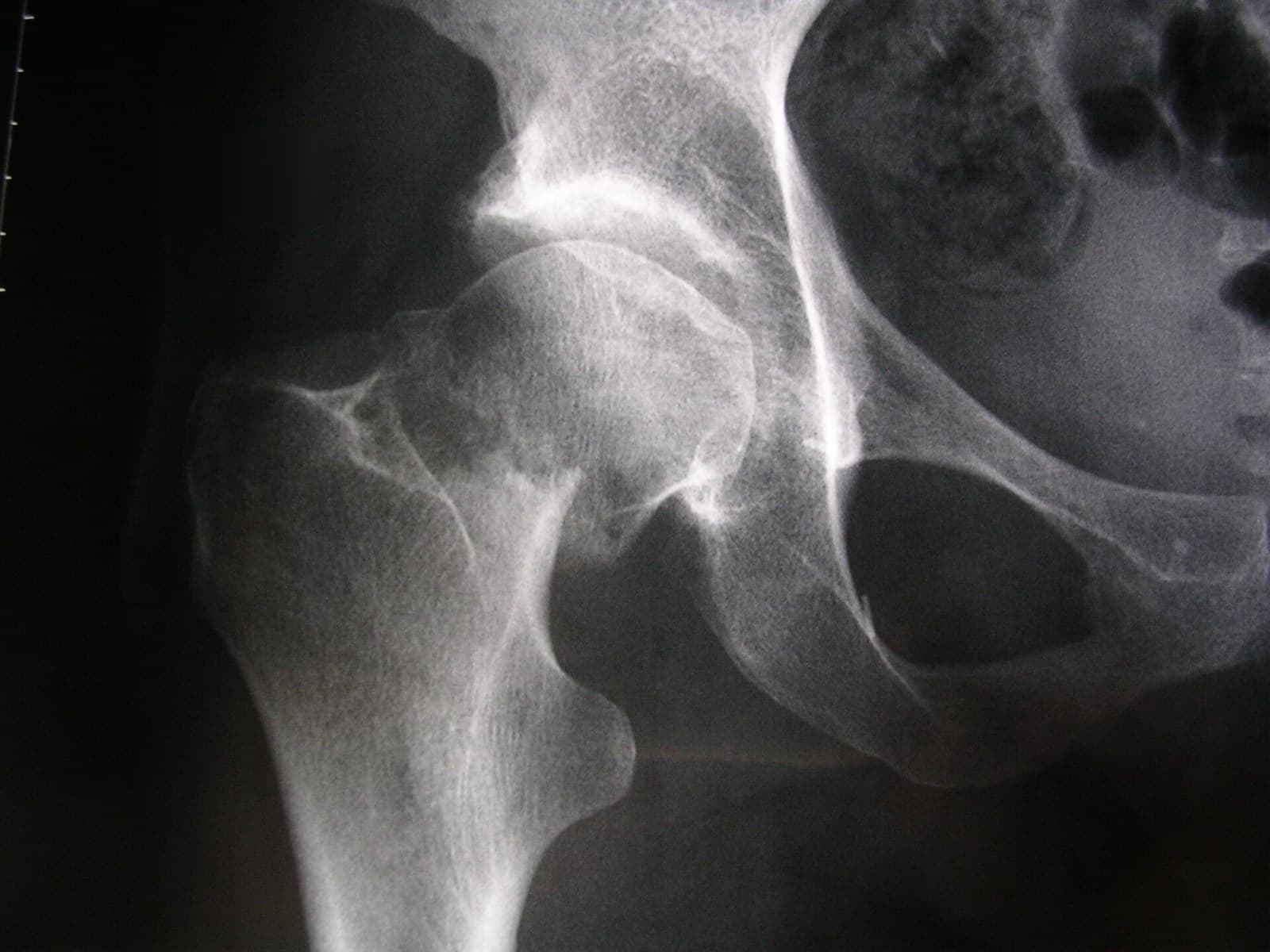 AP X-ray of the right hip with a displaced femoral neck fracture