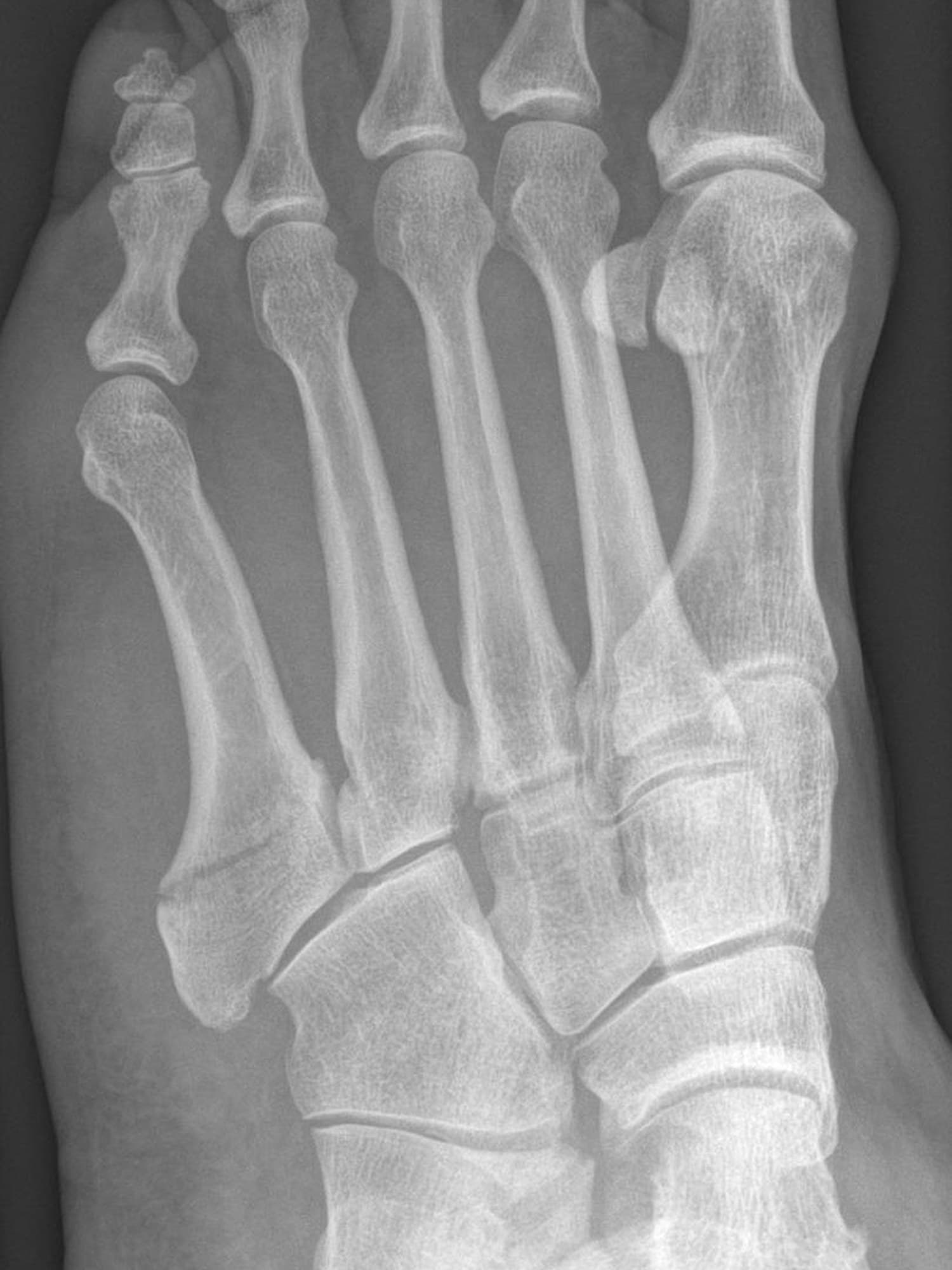 Oblique X-ray of the foot with a true Jones fracture of the fifth metatarsal
