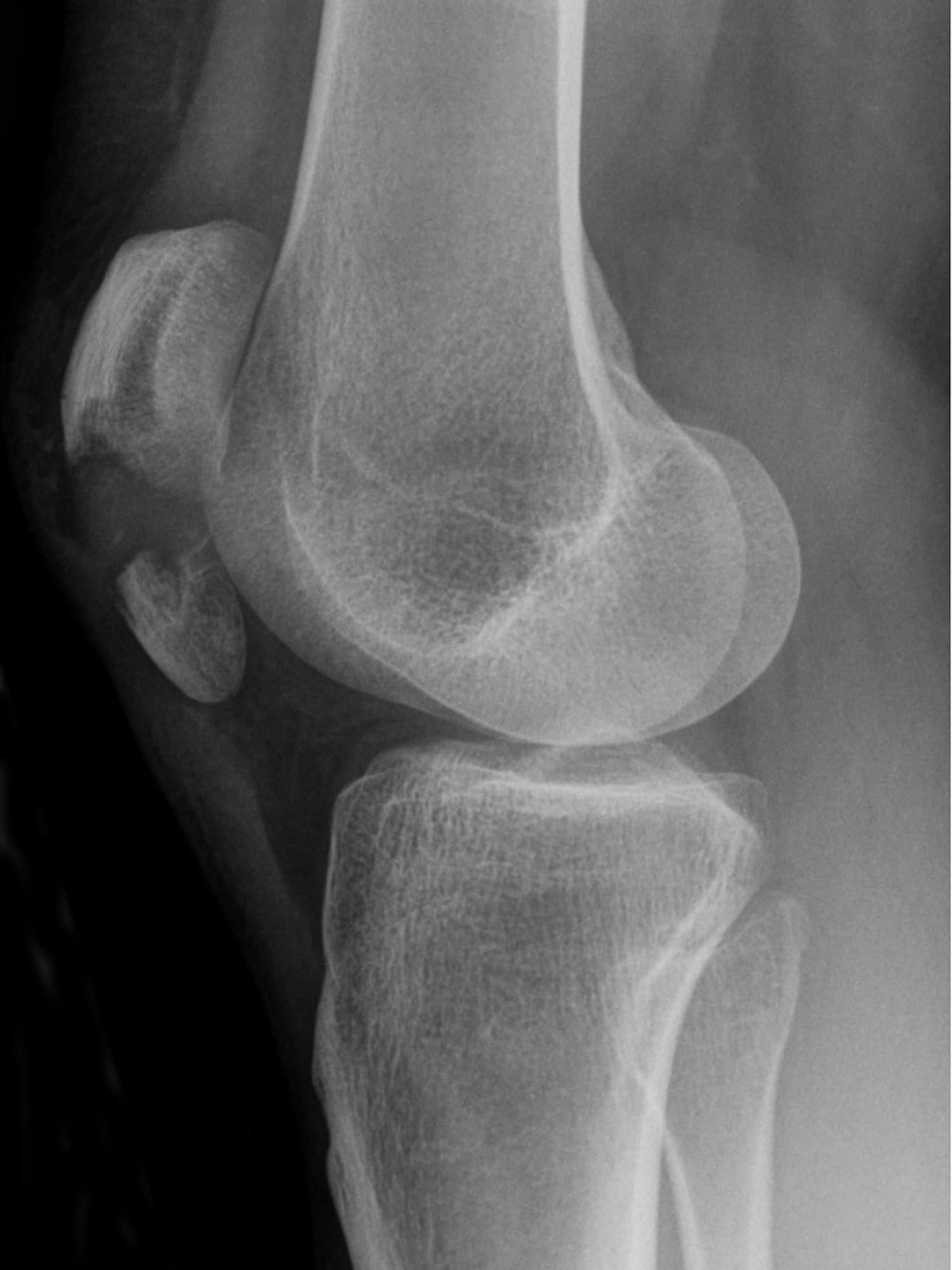 Lateral knee X-ray of a transverse patella fracture