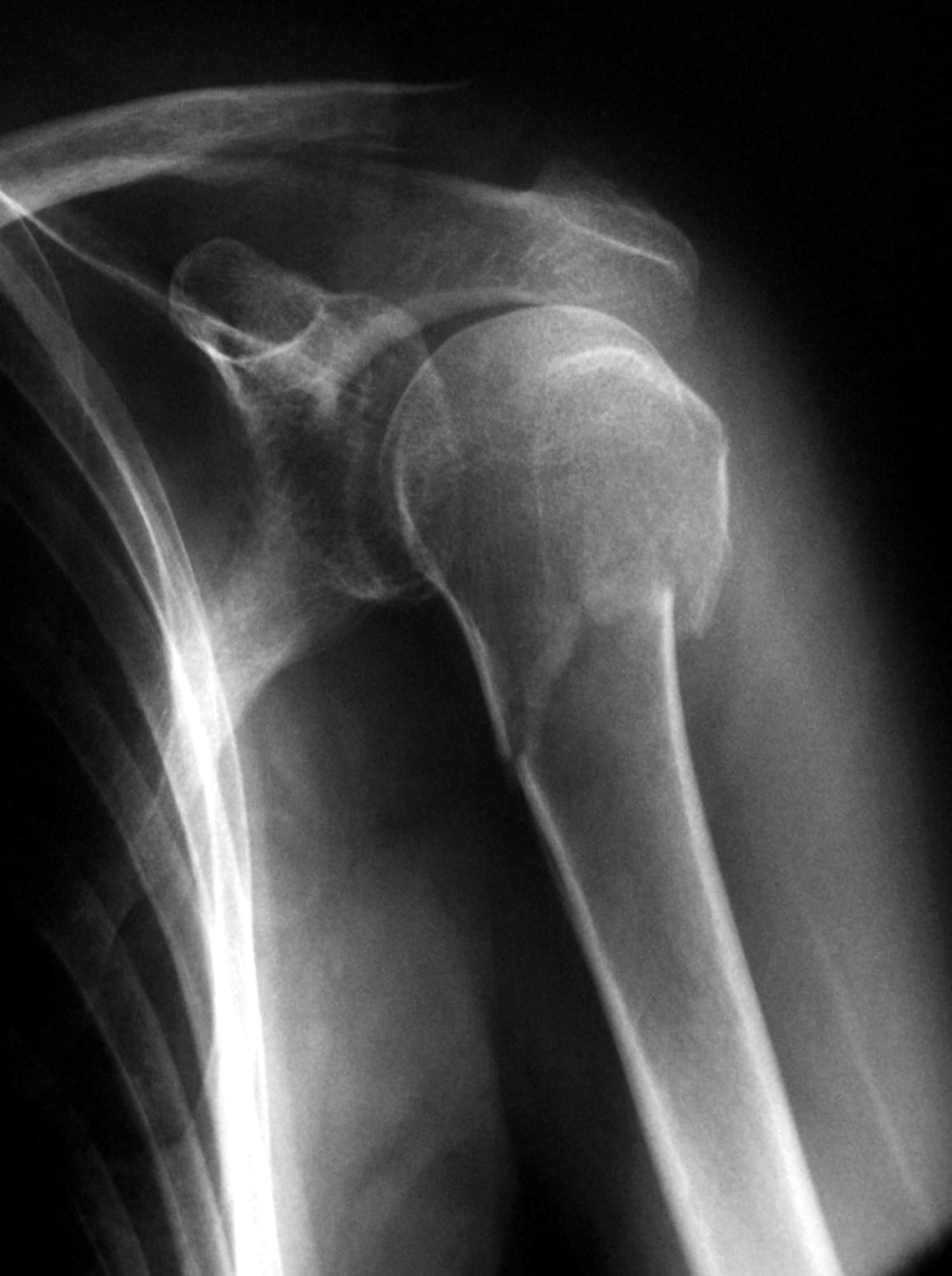 AP shoulder X-ray with a displaced surgical neck fracture of the proximal humerus