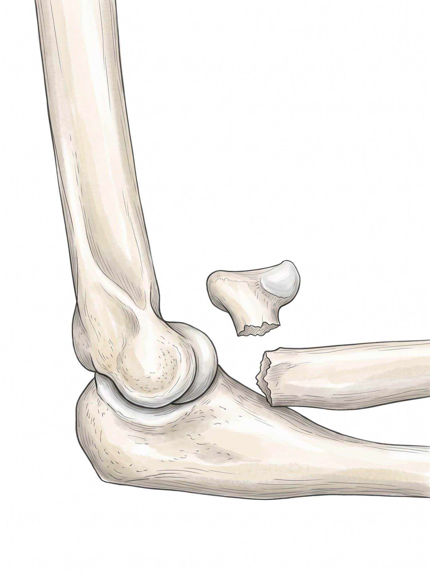 Radial head fracture X-ray and illustration (side view of the elbow): radial head broken off at the neck and displaced