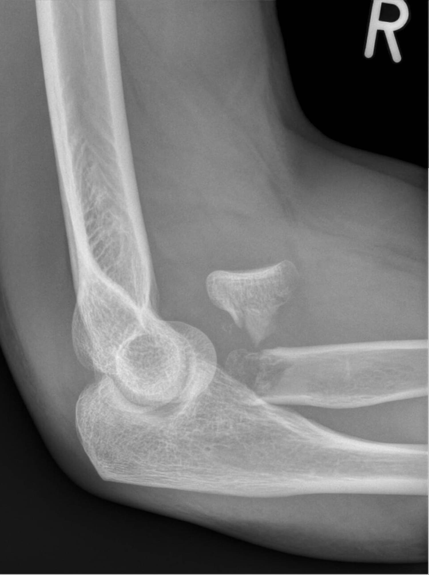 Lateral elbow X-ray with a displaced subcapital radial head fracture