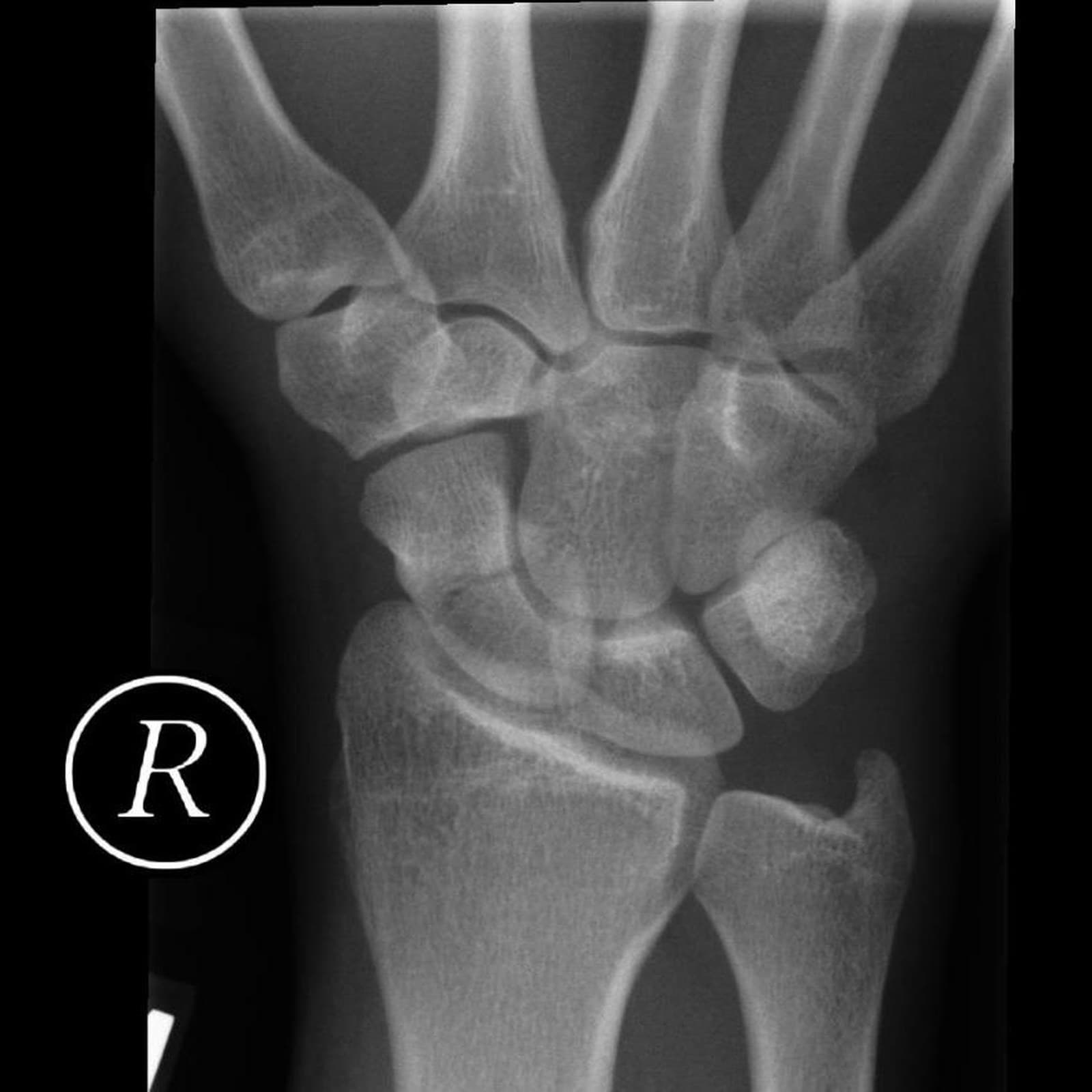 PA X-ray of the right wrist of a 20-year-old with a scaphoid waist fracture