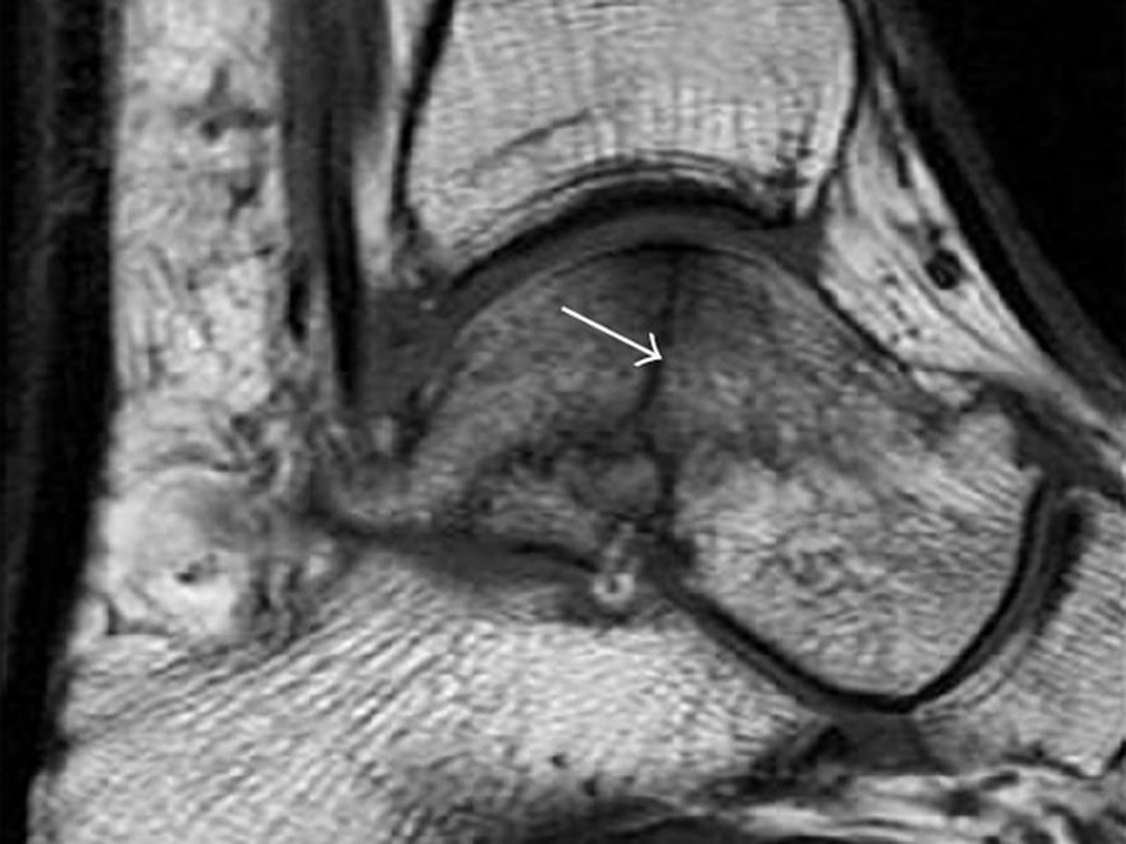 Sagittal T1 MRI of the ankle showing a stress fracture line through the talus within dark bone marrow edema