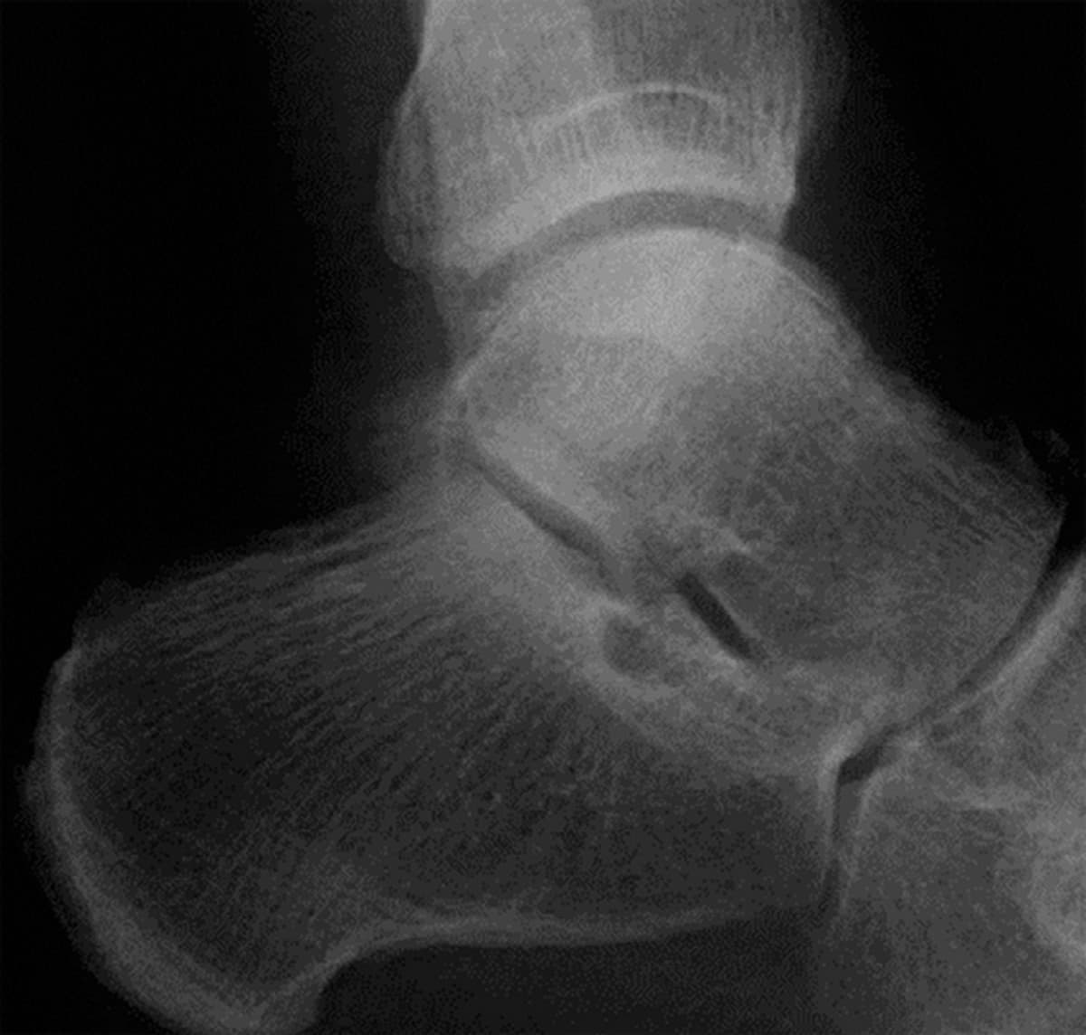 Lateral ankle X-ray one month after symptoms began, appearing normal despite a talus stress fracture