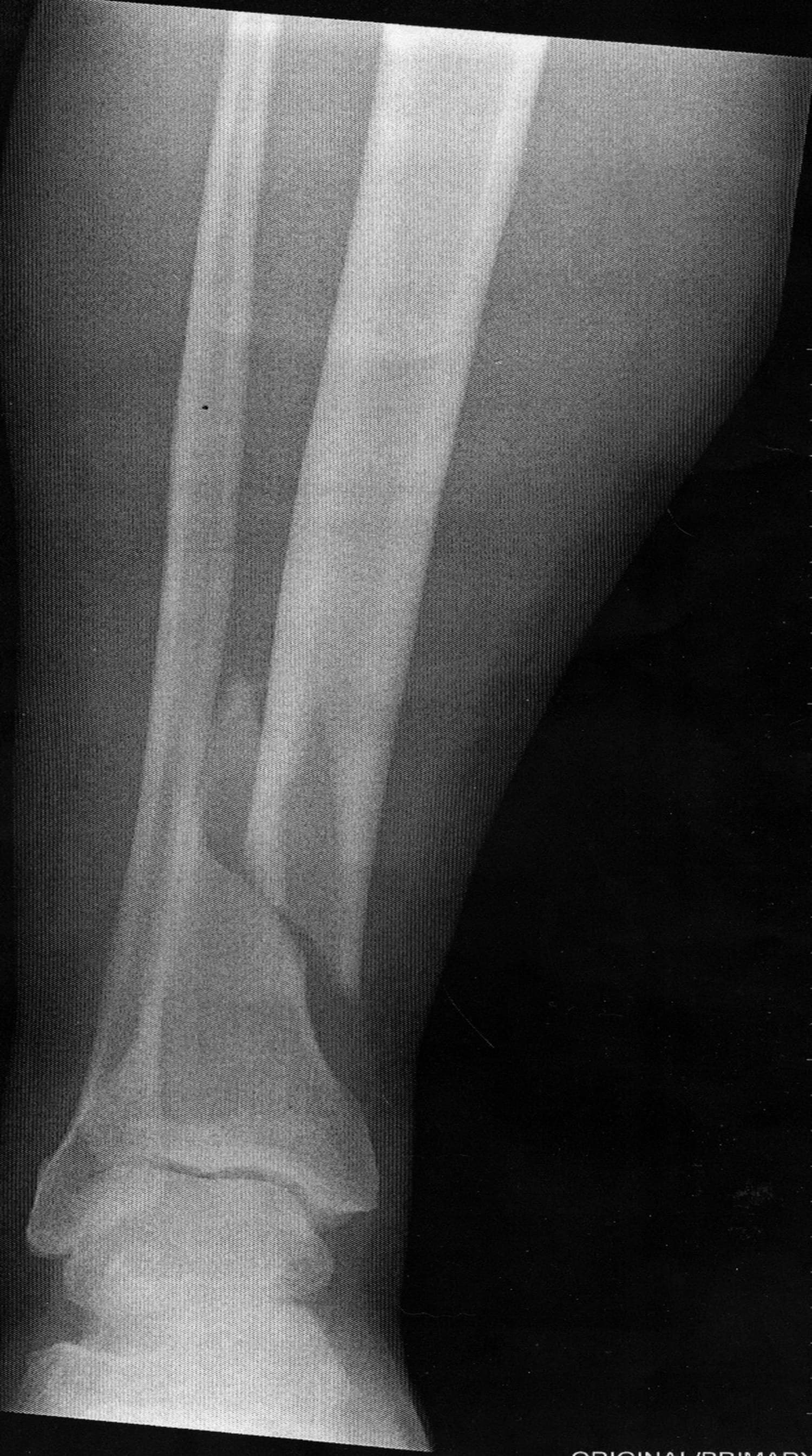 AP X-ray of the right lower leg with a displaced spiral fracture of the distal tibial shaft; the fibula appears intact