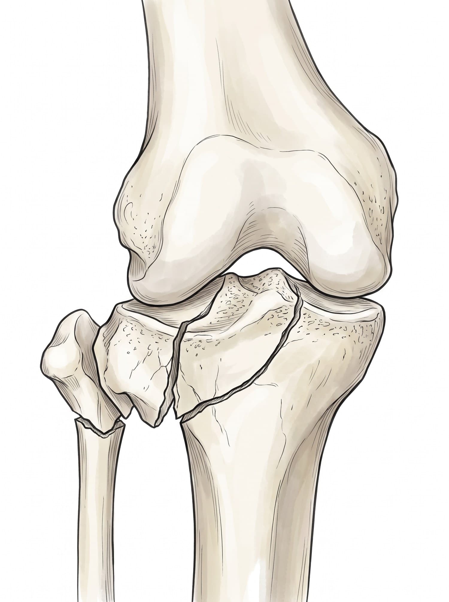 Tibial plateau fracture X-ray and illustration (AP view of the knee): comminuted split-depression fracture of the lateral tibial plateau with a fibular neck fracture