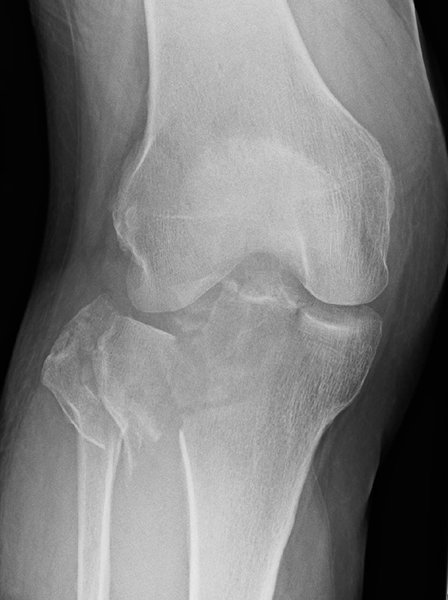 AP knee X-ray of a severe lateral tibial plateau fracture