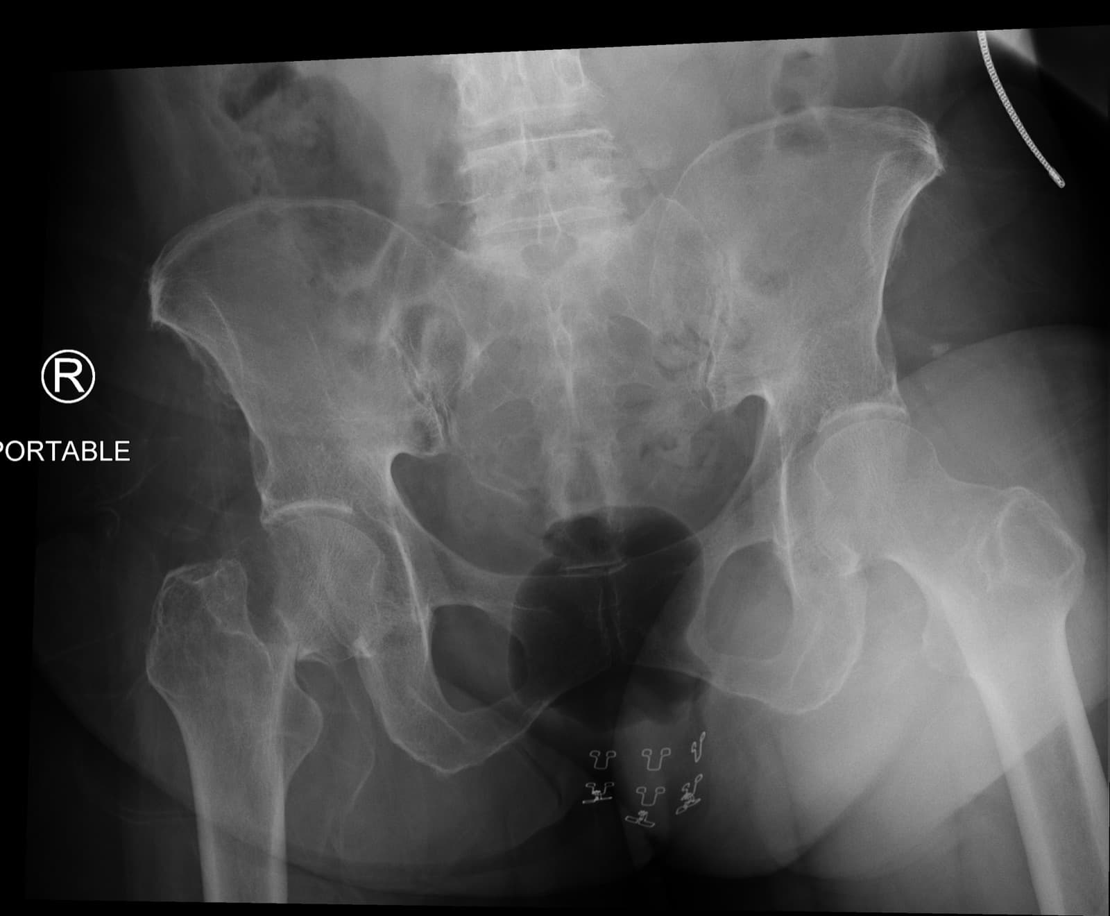 AP pelvis X-ray showing a right femoral neck fracture