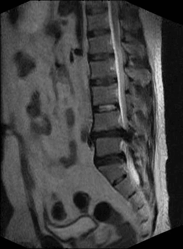 Lumbar disc herniation with caudal migration — original scan