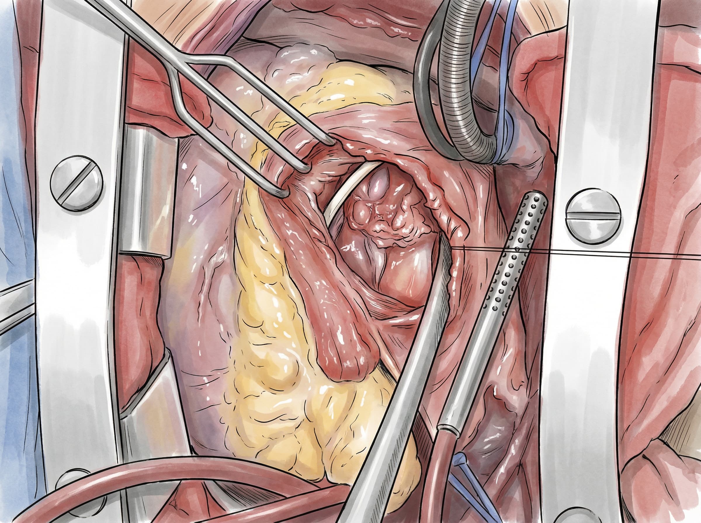 Heart surgery in Netter's academic illustration style