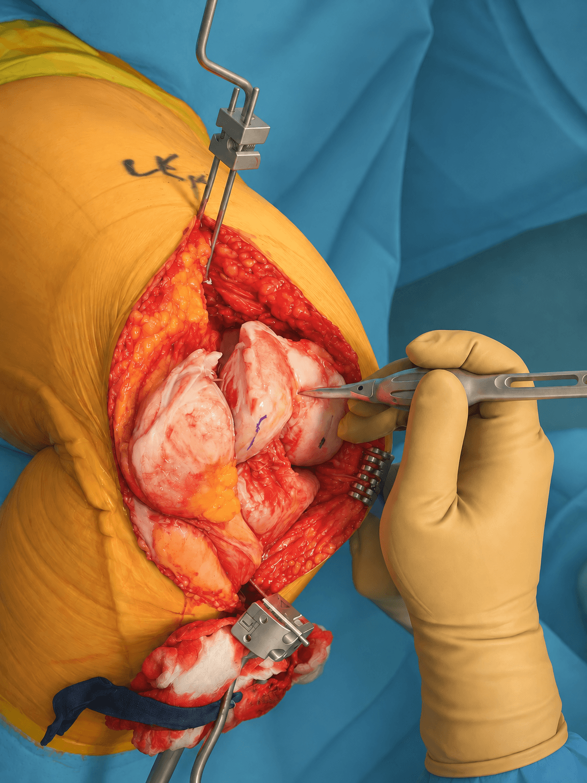 Knee surgery in 3D Medical Render style